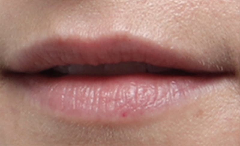 Lip Fillers Before & After Gallery - Patient 156246 - Image 7