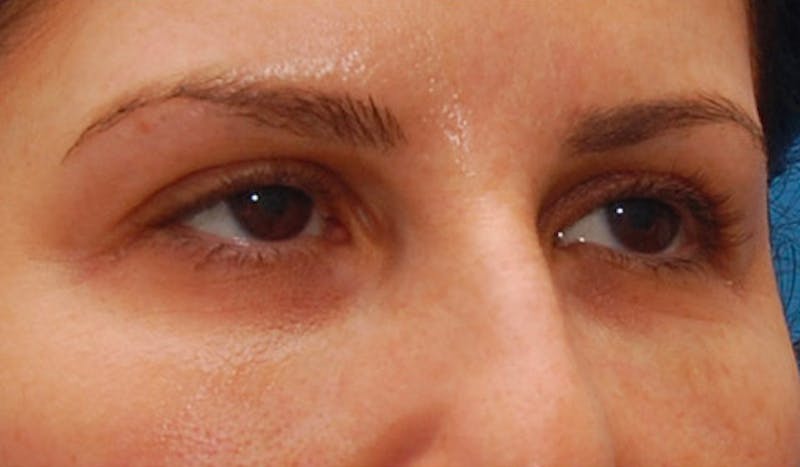 Fillers Before & After Gallery - Patient 987597 - Image 3