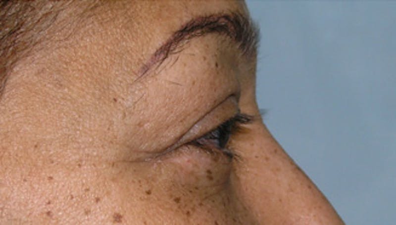 Eyelid Surgery Before & After Gallery - Patient 424184 - Image 6