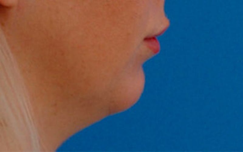 Chin Surgery Before & After Gallery - Patient 751069 - Image 1