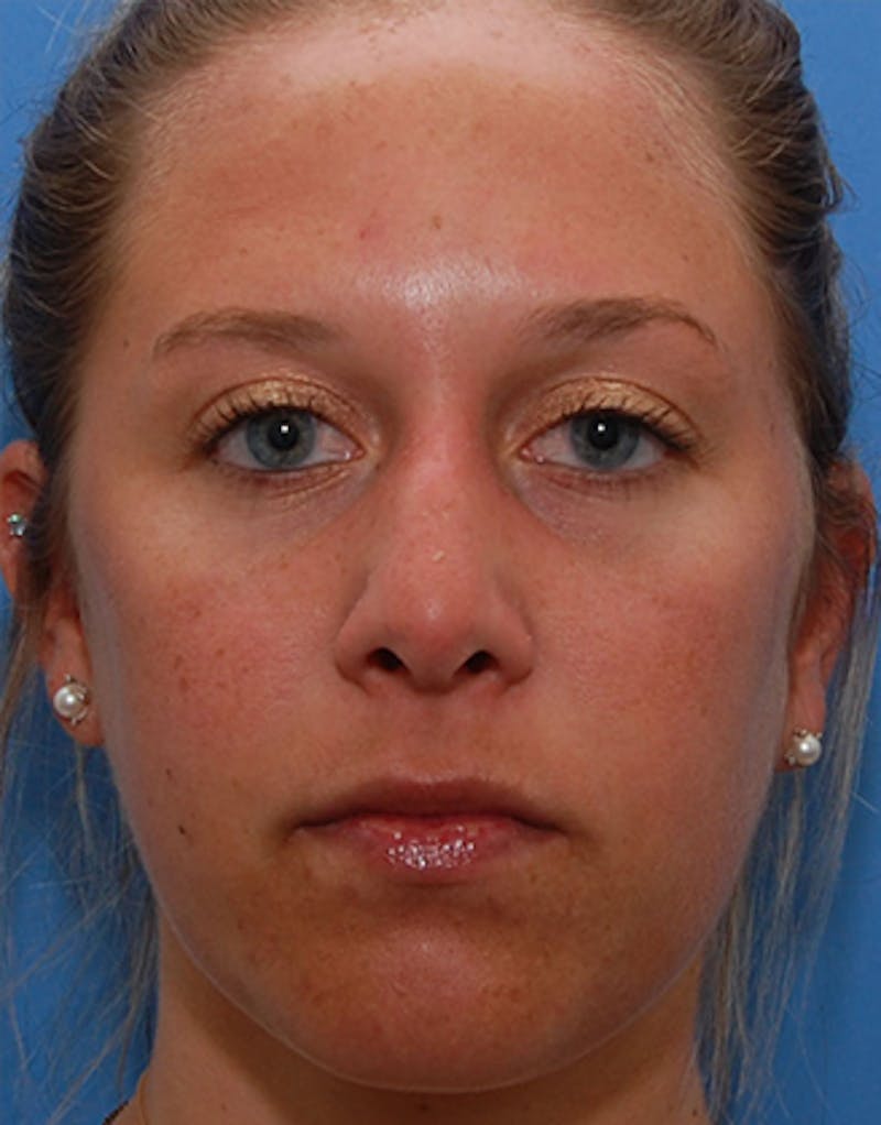 Rhinoplasty Before & After Gallery - Patient 388796 - Image 5