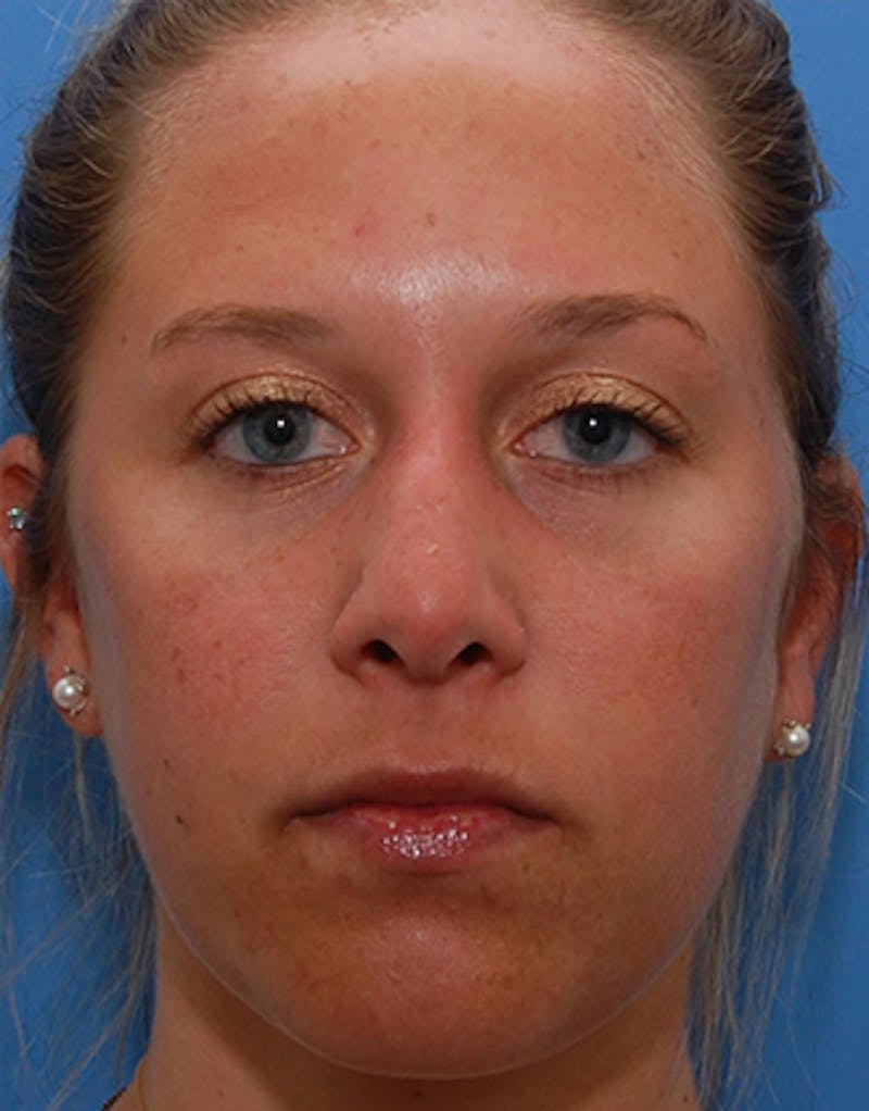 Rhinoplasty  Before & After Gallery - Patient 145106 - Image 5