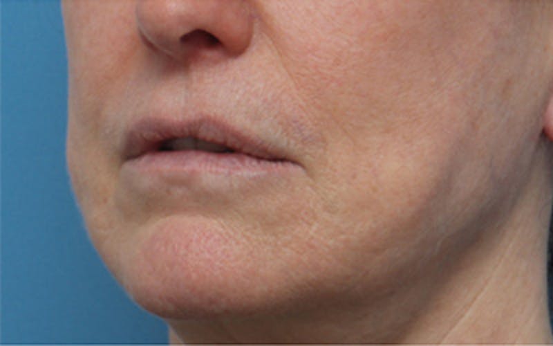 Dermabrasion Before & After Gallery - Patient 150713 - Image 5
