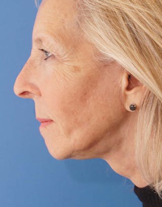 Facelift Before & After Gallery - Patient 112261 - Image 8