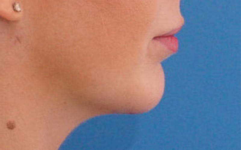 Chin Surgery Before & After Gallery - Patient 751069 - Image 2