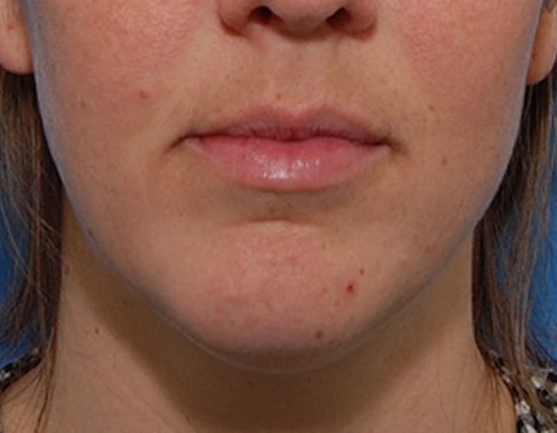 Kybella Before & After Gallery - Patient 426266 - Image 1