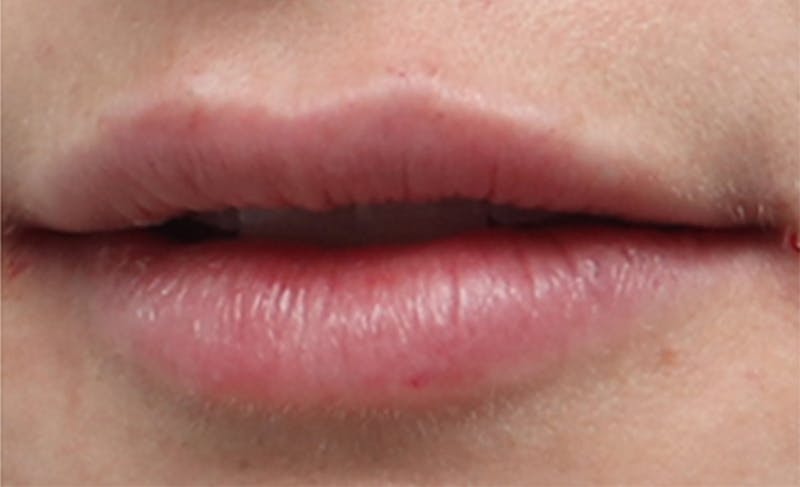 Lip Fillers Before & After Gallery - Patient 156246 - Image 8