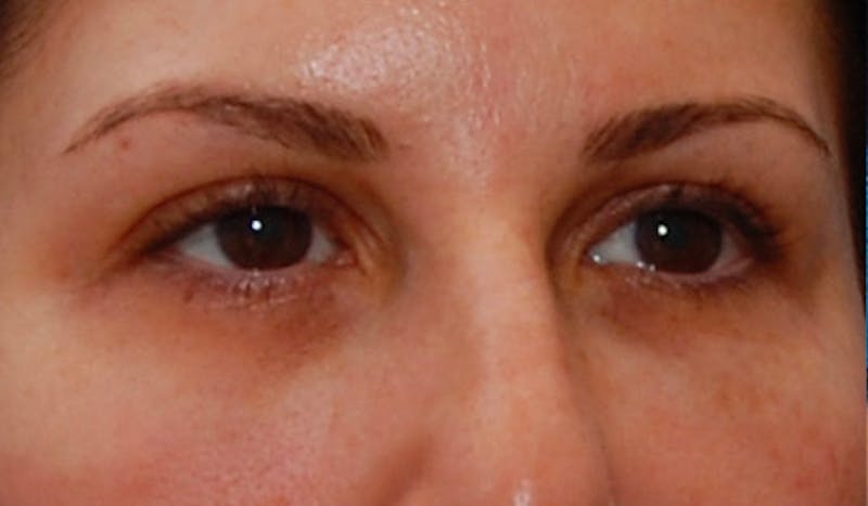 Fillers Before & After Gallery - Patient 987597 - Image 4