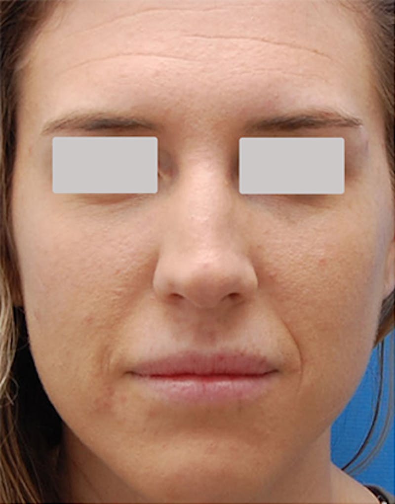BOTOX Before & After Gallery - Patient 210353 - Image 1