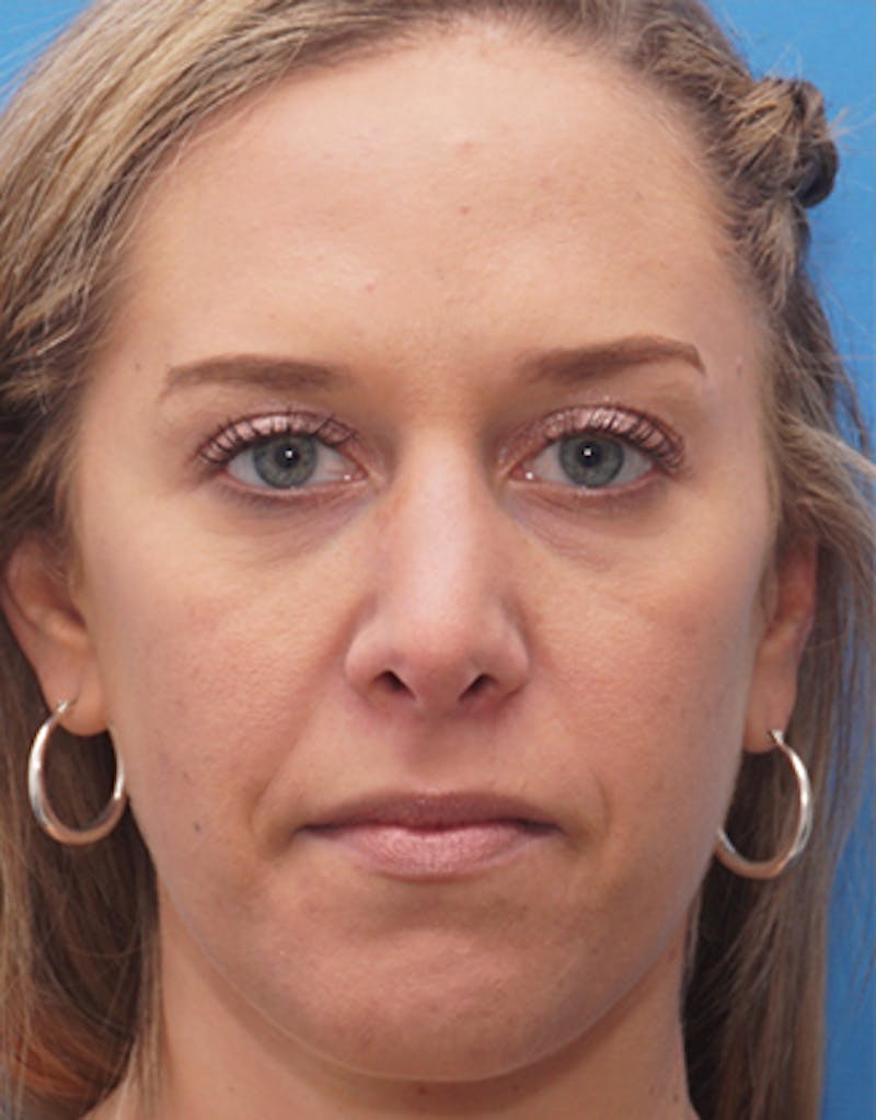 Rhinoplasty  Before & After Gallery - Patient 145106 - Image 6