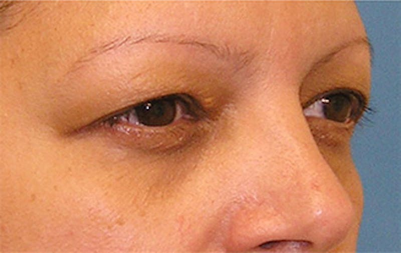 Patient Vkf1NnsORm-F-HBgfjNggw - Eyelid Surgery Before & After Photos