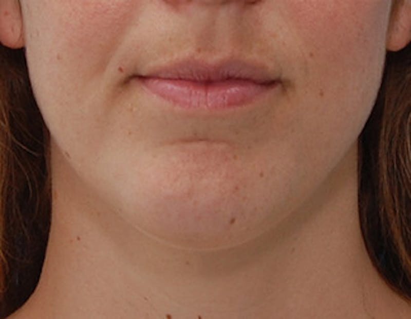 Kybella Before & After Gallery - Patient 426266 - Image 2