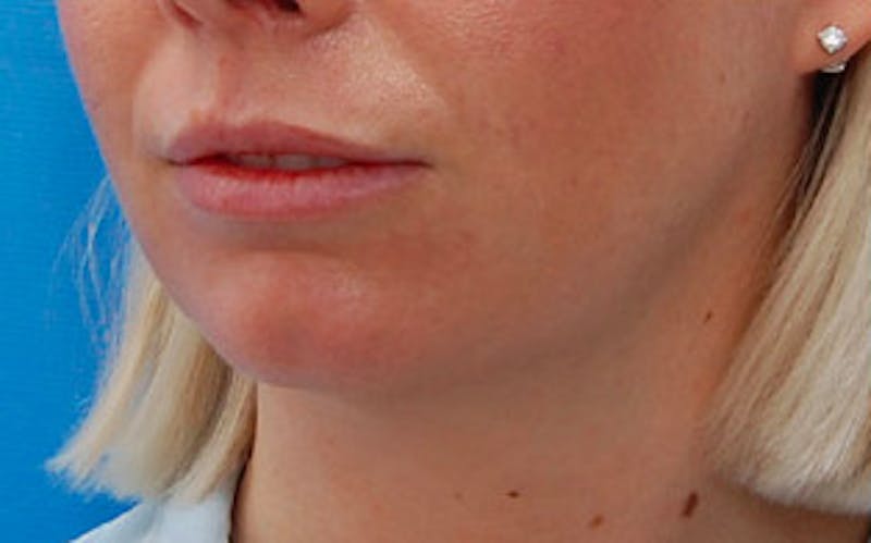 Chin Surgery Before & After Gallery - Patient 751069 - Image 3