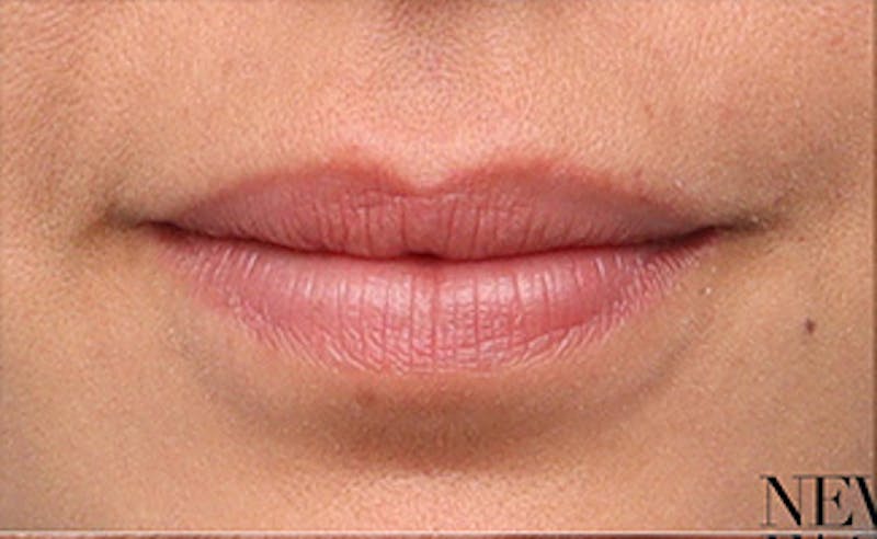 Lip Fillers Before & After Gallery - Patient 351889 - Image 1