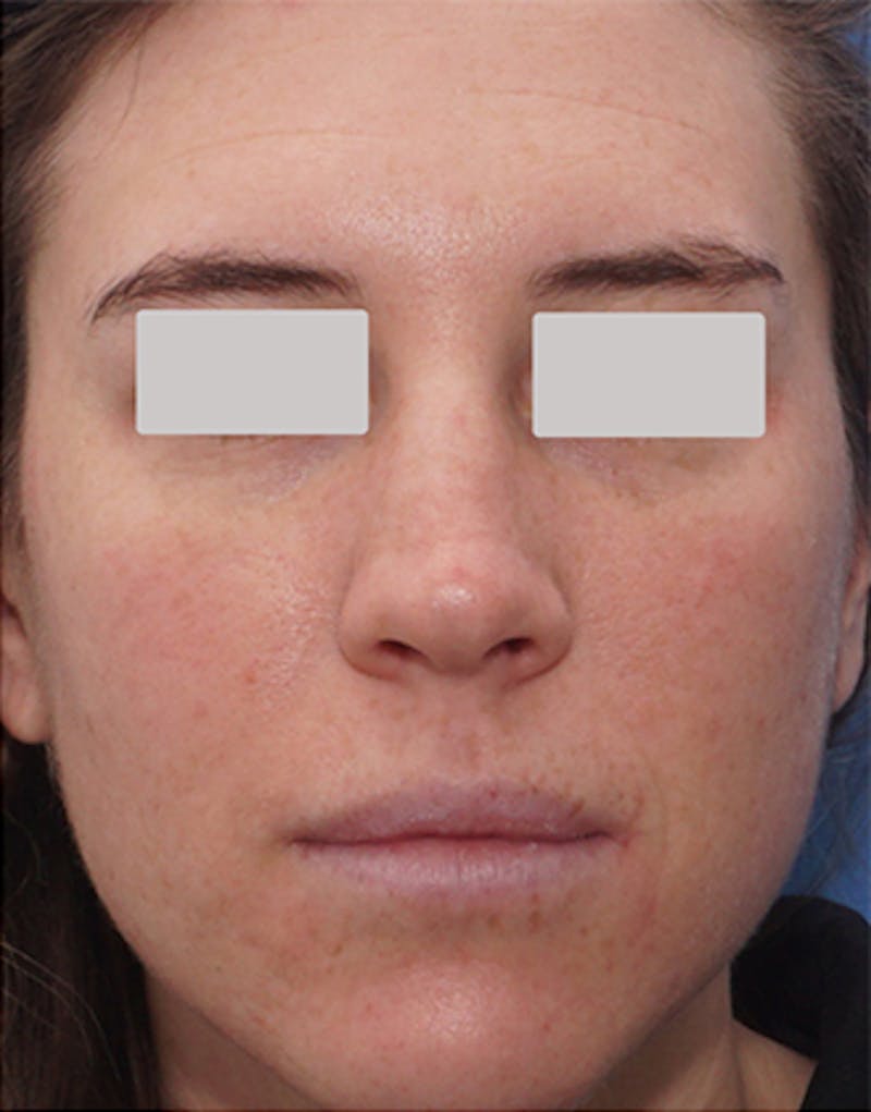 BOTOX Before & After Gallery - Patient 210353 - Image 2