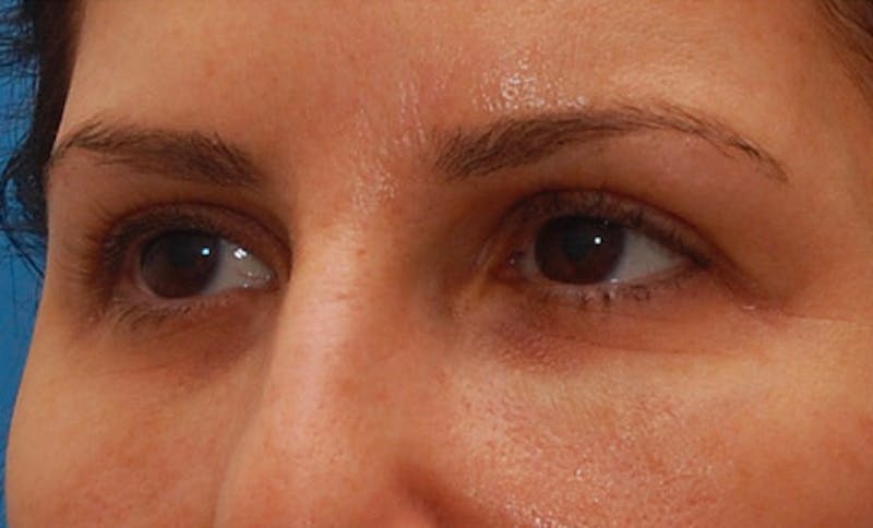 Fillers Before & After Gallery - Patient 987597 - Image 5