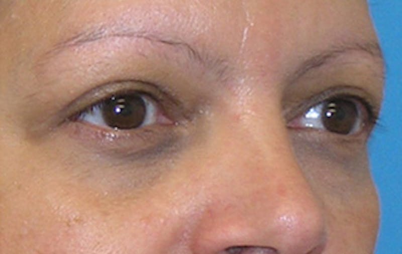 Eyelid Surgery Before & After Gallery - Patient 639891 - Image 2