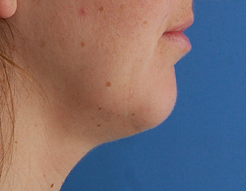 Kybella Before & After Gallery - Patient 426266 - Image 3