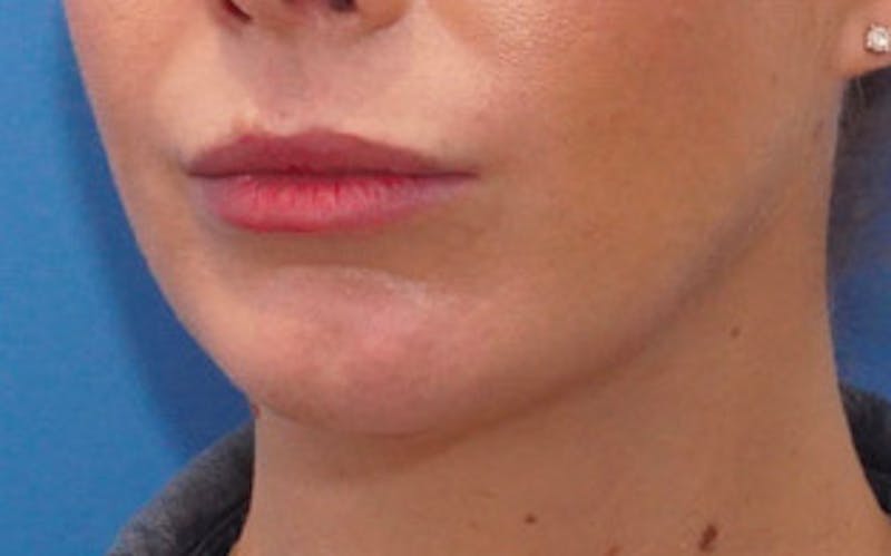 Chin Surgery Before & After Gallery - Patient 751069 - Image 6