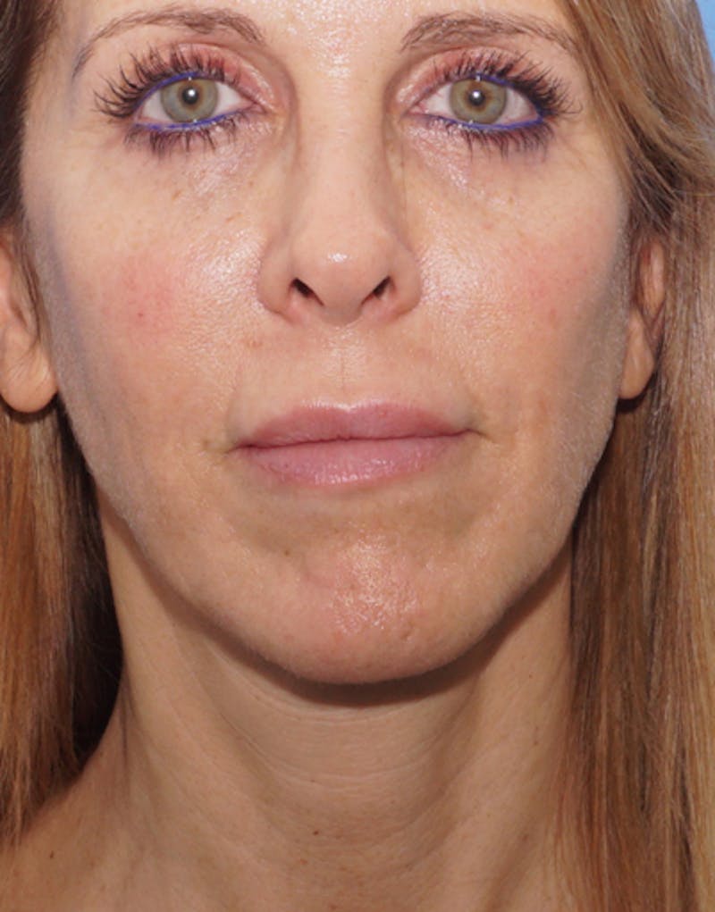 FaceTite Before & After Gallery - Patient 417816 - Image 2