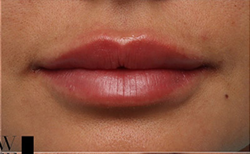 Lip Fillers Before & After Gallery - Patient 351889 - Image 2