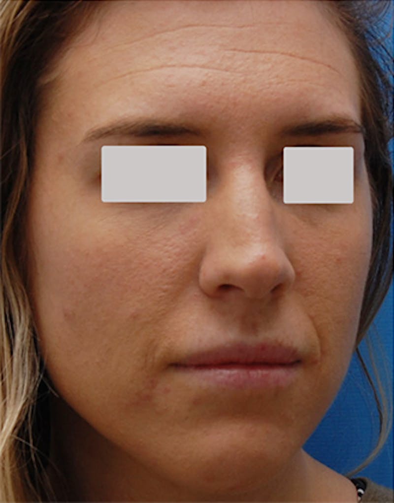 BOTOX Before & After Gallery - Patient 210353 - Image 3