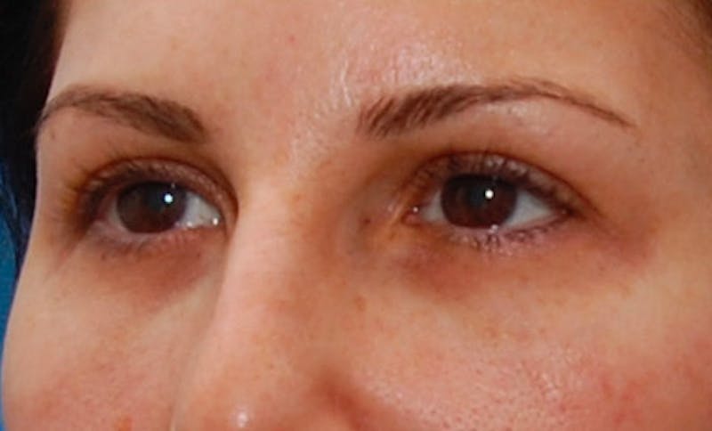 Fillers Before & After Gallery - Patient 987597 - Image 6
