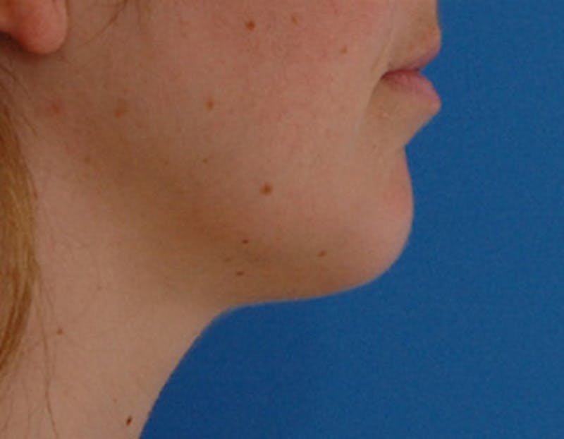 Kybella Before & After Gallery - Patient 426266 - Image 4