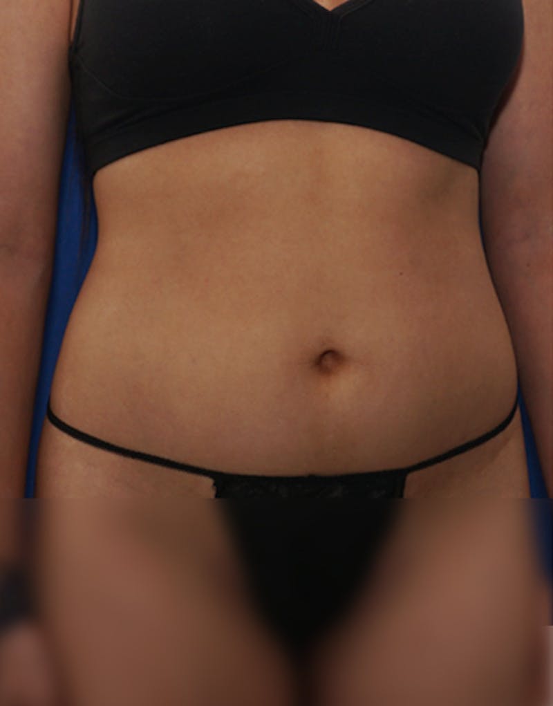 BodyTite Before & After Gallery - Patient 201215 - Image 7