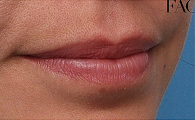 Lip Fillers Before & After Gallery - Patient 351889 - Image 3