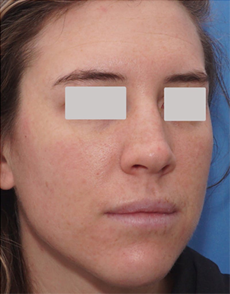 BOTOX Before & After Gallery - Patient 210353 - Image 4