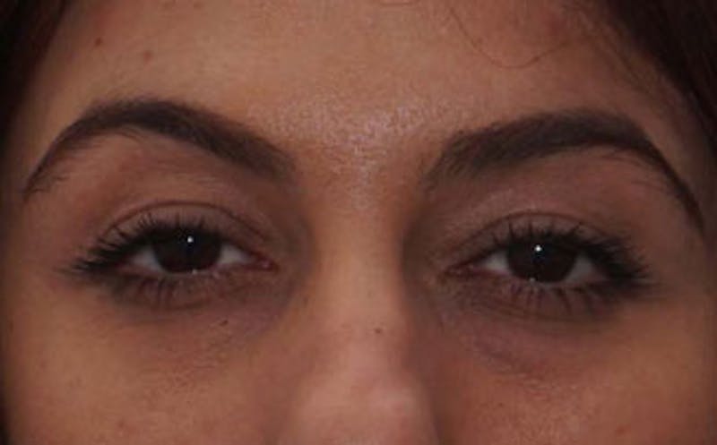 Fillers Before & After Gallery - Patient 214234 - Image 1