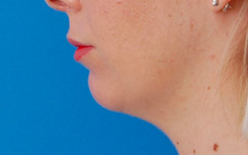 Chin Surgery Before & After Gallery - Patient 751069 - Image 7