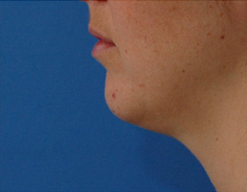 Kybella Before & After Gallery - Patient 426266 - Image 5
