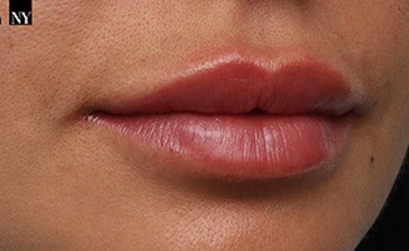 Lip Fillers Before & After Gallery - Patient 351889 - Image 4