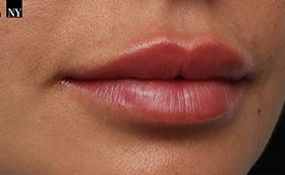 Lip Fillers Before & After Gallery - Patient 351889 - Image 4