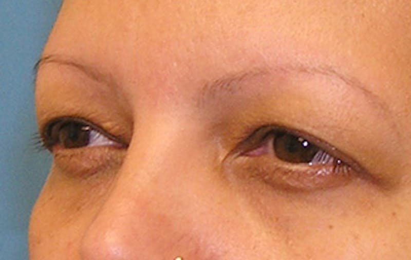 Eyelid Surgery Before & After Gallery - Patient 639891 - Image 3