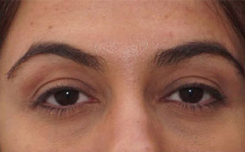 Fillers Before & After Gallery - Patient 214234 - Image 2