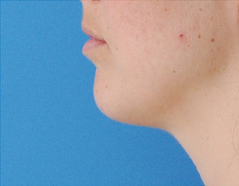 Kybella Before & After Gallery - Patient 426266 - Image 6