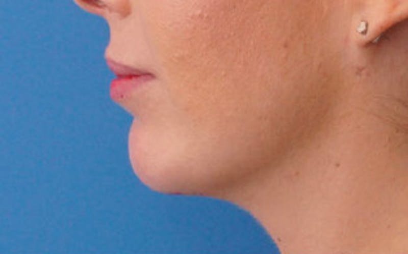 Chin Surgery Before & After Gallery - Patient 751069 - Image 8
