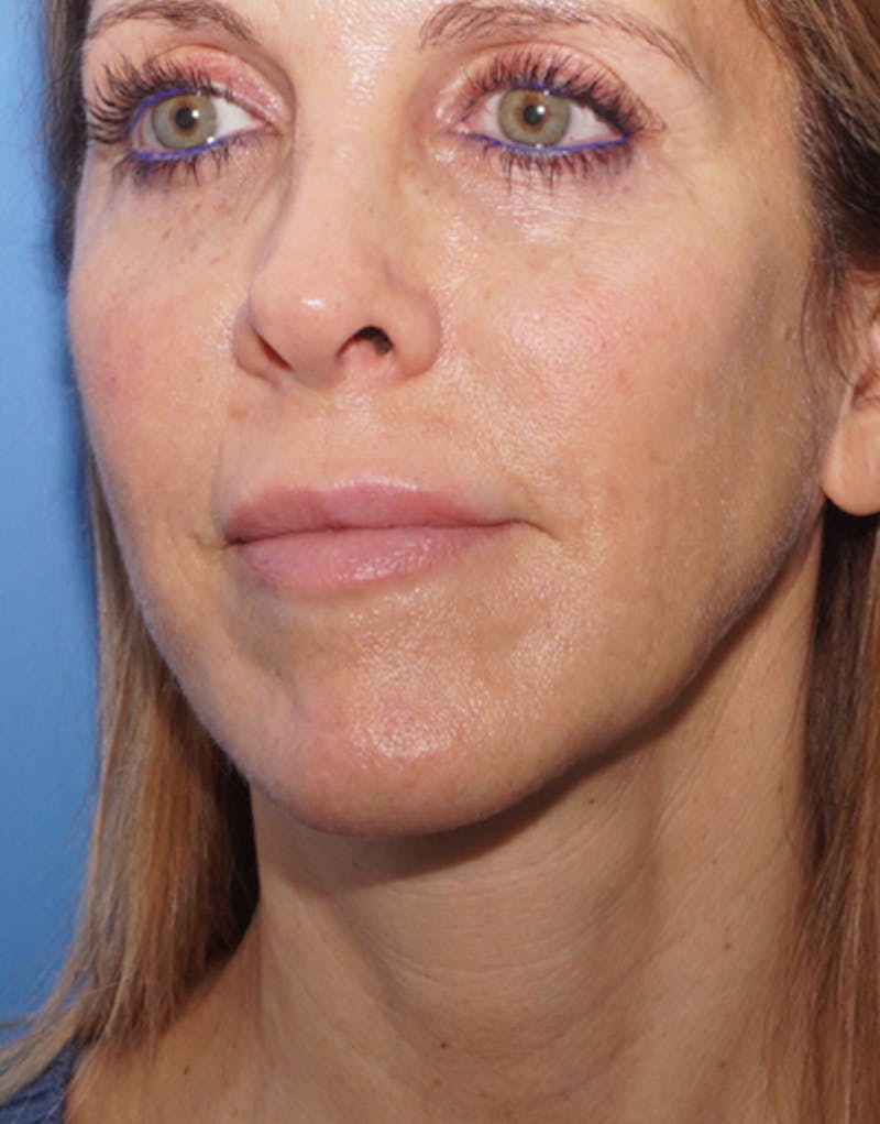 FaceTite Before & After Gallery - Patient 417816 - Image 4