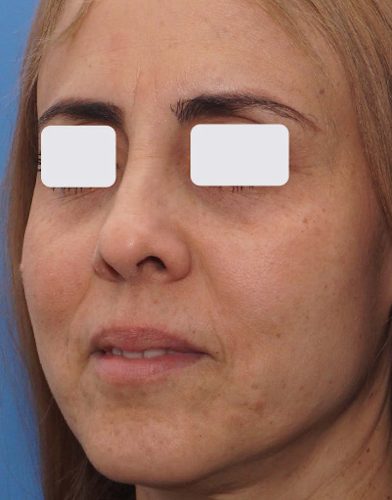 BOTOX Before & After Gallery - Patient 841254 - Image 1
