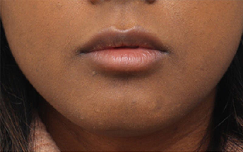 Lip Fillers Before & After Gallery - Patient 192837 - Image 1