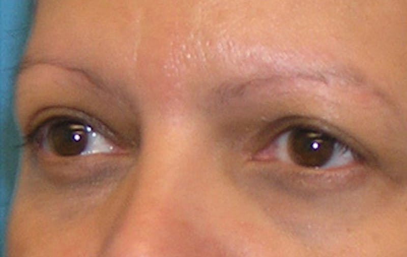 Eyelid Surgery Before & After Gallery - Patient 639891 - Image 4