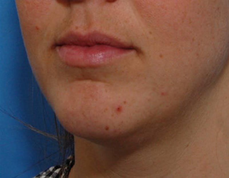 Kybella Before & After Gallery - Patient 426266 - Image 7