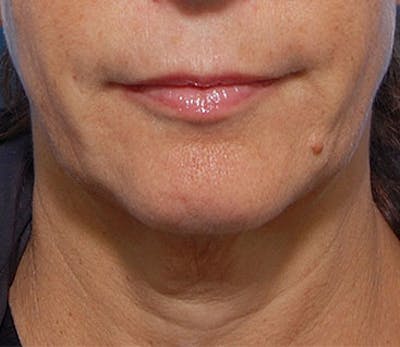 Fractora / Morpheus Before & After Gallery - Patient 221962 - Image 1