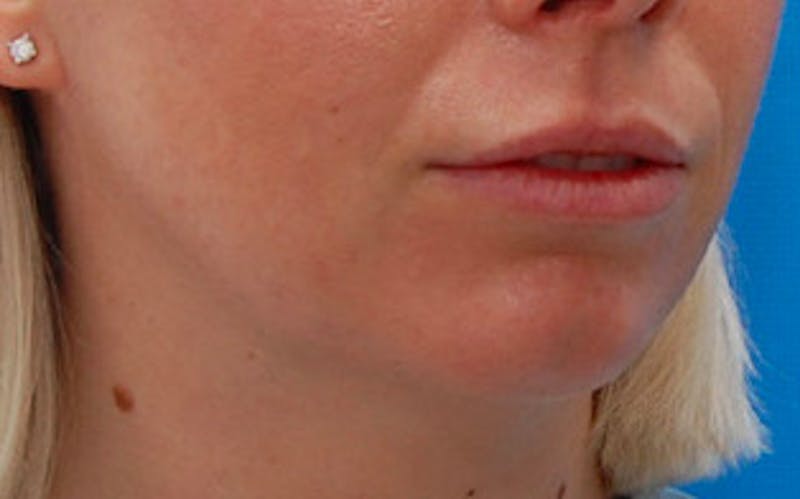 Chin Surgery Before & After Gallery - Patient 751069 - Image 7