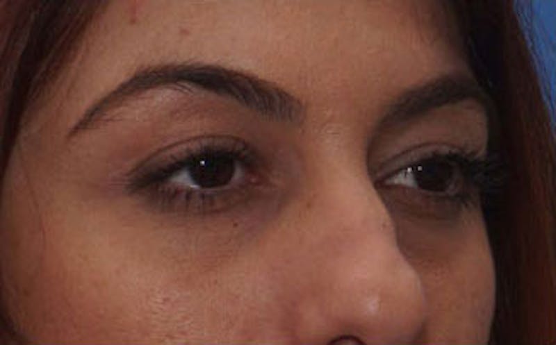 Fillers Before & After Gallery - Patient 214234 - Image 3