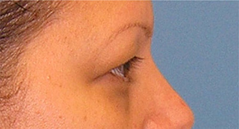 Eyelid Surgery Before & After Gallery - Patient 639891 - Image 5
