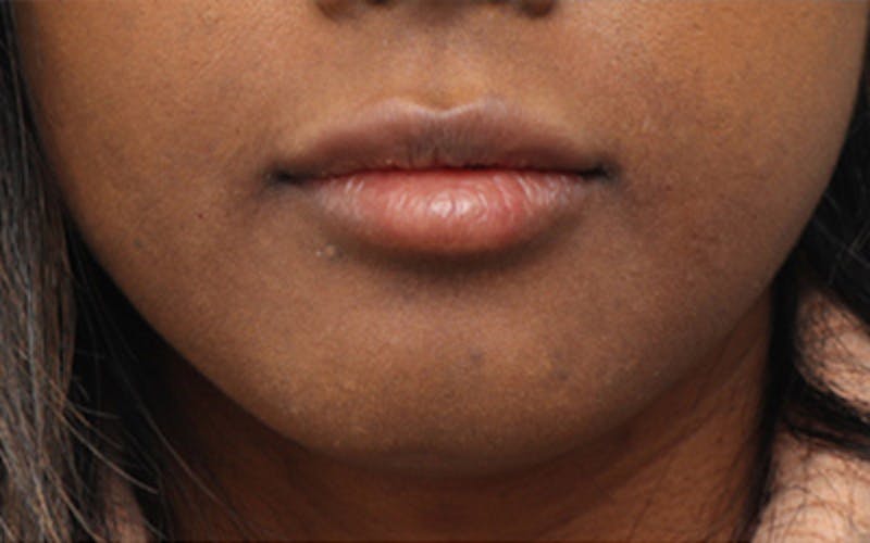 Lip Fillers Before & After Gallery - Patient 192837 - Image 2